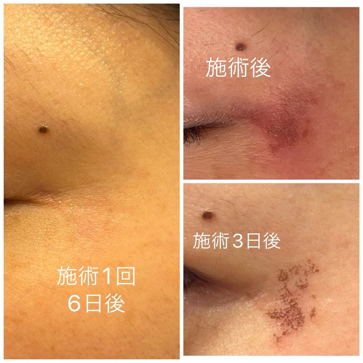 40代女性　Mさま　（4回施術）