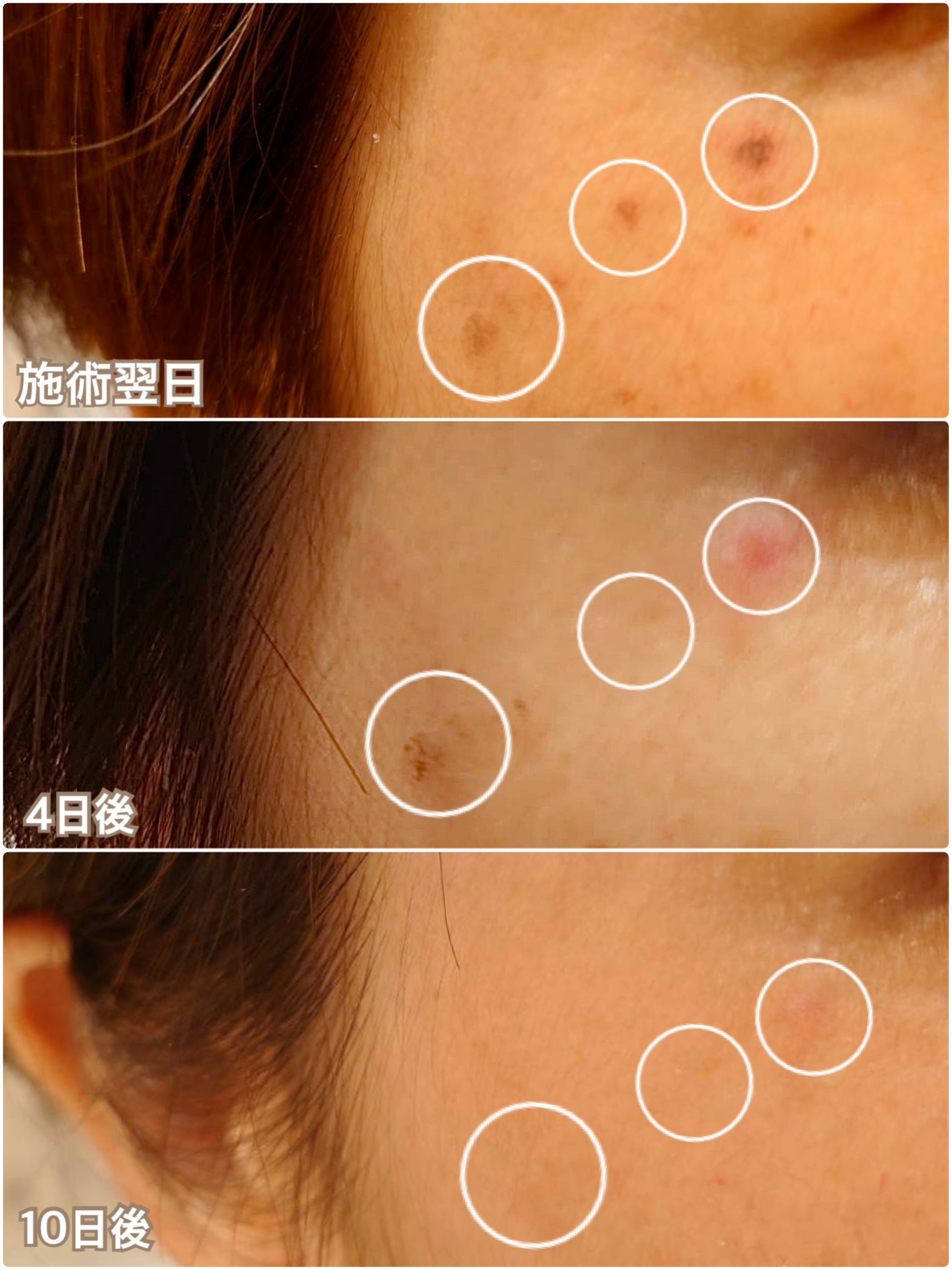 ４０代女性　Rさま（６回施術）